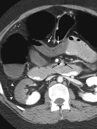 Figure 26-11, Intravenous and oral contrast-enhanced computed tomography scan of the abdomen and pelvis demonstrates wedge-shaped areas of nonenhancement in the right kidney (arrowheads) consistent with infarct in a patient with superior mesenteric artery embolism (black arrows). Nonenhancement of bowel wall (white arrows) is also a sign of ischemia.