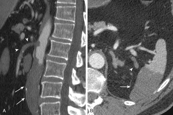 Figure 26-13, A, Intravenous contrast-enhanced computed tomography of the abdomen demonstrates embolic occlusion of the proximal superior mesenteric artery (arrowheads) as well as distal aorta (arrows). B, A wedge-shaped area of hypoattenuation in the spleen (arrow) is consistent with infarct from splenic artery embolism (arrowhead).