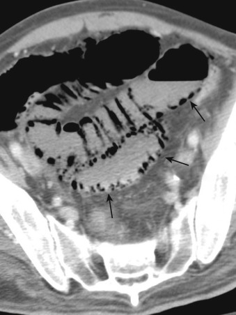 Figure 26-14, Intravenous and oral contrast-enhanced computed tomography of the abdomen and pelvis demonstrates linear foci of gas (arrows) within the wall of small bowel, consistent with pneumatosis intestinalis.