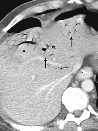 Figure 26-15, Intravenous contrast-enhanced computed tomography of the abdomen and pelvis demonstrates branching foci of air attenuation (arrows) extending into the periphery of the liver, consistent with portal venous gas.