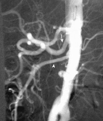 Figure 26-16, Lateral aortogram demonstrates a normal celiac artery (arrow) and origin of the superior mesenteric artery (arrowhead).