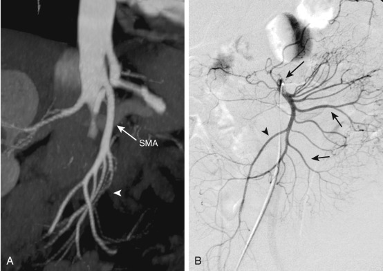 Figure 26-2, A, Maximum intensity projection from computed tomography angiogram of the abdomen demonstrates the superior mesenteric artery (SMA, long arrow) as well as jejunal and ileal branches (arrowhead). B, Selective contrast injection of the superior mesenteric artery (long arrow) demonstrates multiple jejunal and ileal branches (short arrows) as well as the ileocolic artery (arrowhead).