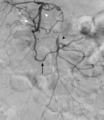 Figure 26-3, Selective contrast injection of the gastroduodenal artery (white arrowhead) demonstrates the superior pancreaticoduodenal arteries (white arrow), which anastomose with the inferior pancreaticoduodenal arteries (black arrow) derived from the superior mesenteric artery (black arrowhead).