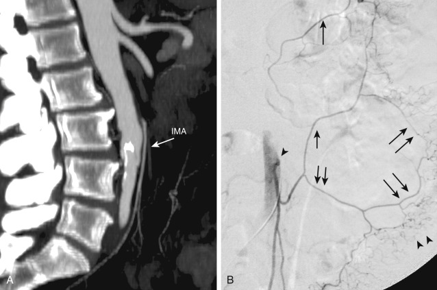 Figure 26-4, A, Maximum intensity projection from a computed tomography angiogram of the abdomen demonstrates the inferior mesenteric artery (IMA, arrow). B, Selective contrast injection of the inferior mesenteric artery (single arrowhead) demonstrates the ascending (single short arrow) and descending (double short arrows) branches of the left colic artery. The ascending branch anastomoses with the left branch of the middle colic artery (single long arrow), which is derived from the superior mesenteric artery. The marginal artery of Drummond (double long arrows) gives off arborizing vasa rectae (double arrowheads) to colon.