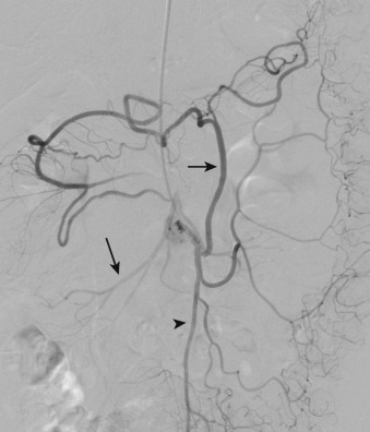 Figure 26-6, Selective contrast injection of the inferior mesenteric artery (arrowhead) demonstrates a prominent arc of Riolan (short arrow). The arc of Riolan bridges the inferior and superior mesenteric arteries (long arrow).