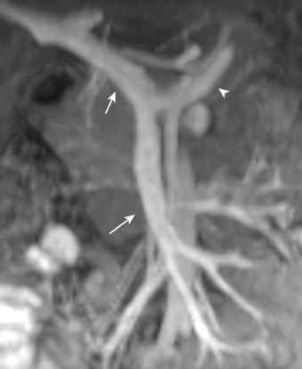 Figure 26-7, Magnetic resonance angiogram demonstrates the superior mesenteric vein (long arrow) joining the splenic vein (arrowhead) to become the portal vein (short arrow).