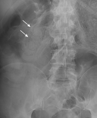 Figure 26-8, Plain radiograph of the abdomen demonstrates curvilinear lucencies (arrows) within the bowel wall, consistent with pneumatosis.