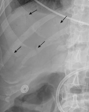 Figure 26-9, Plain radiograph of the abdomen demonstrates branching linear lucencies (arrows) coursing to the periphery of the liver, consistent with portal venous gas.