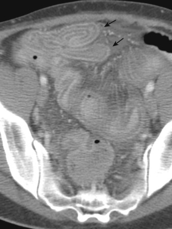 Figure 26-10, Intravenous and oral contrast-enhanced computed tomography scan of the abdomen and pelvis in a man with acute mesenteric ischemia of small bowel secondary to superior mesenteric artery embolism (not shown). A target sign (arrows) is characterized by an outer and inner hyperattenuating and middle hypoattenuating layer.