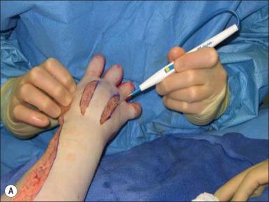 Fig. 54.2, Upper extremity escharotomies and fasciotomies. (A) A patient having completion of dorsal escharotomy incisions. (B) Drawing of dorsal fasciotomy locations. (C) Drawing of dorsal hand fasciotomy locations and a cross-section demonstrating the access to decompress all the compartments of the hand. Note the dorsal incisions decompressing the four dorsal interosseous compartments (incisions B and C), as well as accessing the adductor pollicis compartment via the second dorsal interosseous. The thenar muscles are decompressed via incision “A” volarly and radially, and the hypothenars are decompressed via incision “D” volarly and ulnarly. (D) Example of digital escharotomy incisions. (E) Subsequent escharotomy demonstrating that escharotomy incisions should be made liberally because all eschar will be subsequently resected. (F) Placement of homograft on escharotomized fingers, secured with sutures.