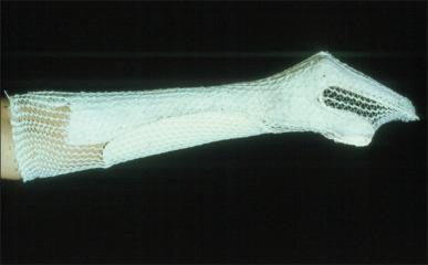 Fig. 54.3, Example of thermoplastic hand splinting. A hand splinted in intrinsic-plus position, also known as the “safe position.” The distal interphalangeal–proximal interphalangeal (DIP-PIP) joints are maintained at full extension, metacarpophalangeal (MCP) joints at 70 degrees flexion, and the wrist at 30 degrees extension.