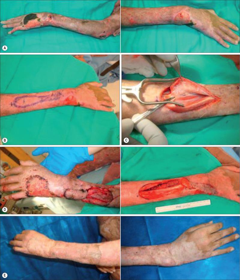 Fig. 54.5, Examples of regional pedicle flaps for hand coverage. (A) Dorsal hand and wrist defect, (B) markings for posterior interosseous nerve flap, (C) elevated in a fasciocutaneous manner, (D) rotated and inset to close a dorsal hand defect. (E) Follow-up image of healed posterior interosseous nerve flap. (F) Line drawing of a distally based radial forearm flap, (G) raised and (H) inset to cover a dorsal hand injury.