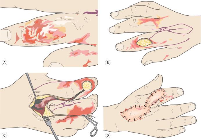 Fig. 54.7, Examples of local flaps for wound coverage in the hand. (A–D) Elevation and inset of dorsal interosseous artery flap. These exist in each web space and can be used to cover the finger out to the distal interphalangeal (DIP) joint with sensate tissue. (E) Line drawing of a z-plasty transposition flap. An incision is made along the contracture scar then flaps raised perpendicular at angles of 60 degrees. The flaps are then transposed, increasing the length of the scar. Typically flaps with tip angles of 60 degrees will increase in length of a contracture by 60% (75% by calculation). (F) Line drawings, elevation, and inset of neurovascular-island flap which can effectively cover the fingers, including the pad, with sensate glabrous tissue. (G–J) Line drawings, elevation, and inset of cross-finger flap which can effectively cover any part of the finger. (K) Line drawing of a hand with a flexion contracture of the small finger and an unstable thumb amputation wound marked with a Limberg (rhomboid) flap closure that will deepen the first web space and close the defect. The internal angles of the Limberg flap are 60 and 120 degrees, the width equals a to a' and the donor defect of b to b' must close primarily. (L) Line drawing showing the Limberg flap rotated into position as well as the flexion contracture of the small finger released by transposition of multiple z-plasty flaps.