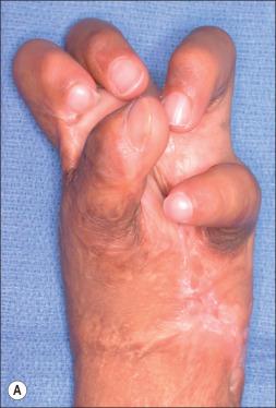 Fig. 54.6, Release of palmar flexion contracture with split-thickness skin grafts (STSG). (A) Palmar contracture in a 7-year-old child. (B) The tissue deficit created after releasing the contracture and extending the fingers manifests the true skin deficiency. (C) STSG inset into the defect. The digits held in extension with intramedullary K-wires. (D) The release of the digits achieved by palmar release.