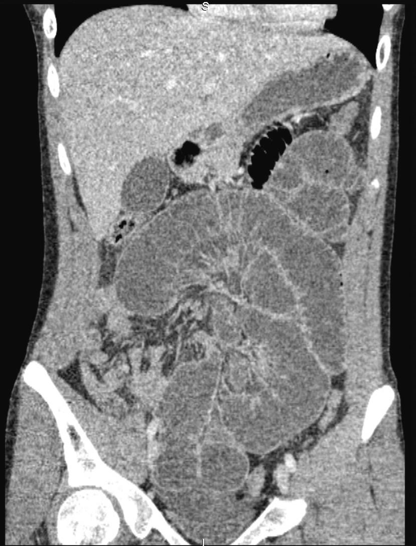 Figure 15.1, Multislice computed tomography with intravenous contrast demonstrating small-bowel obstruction.