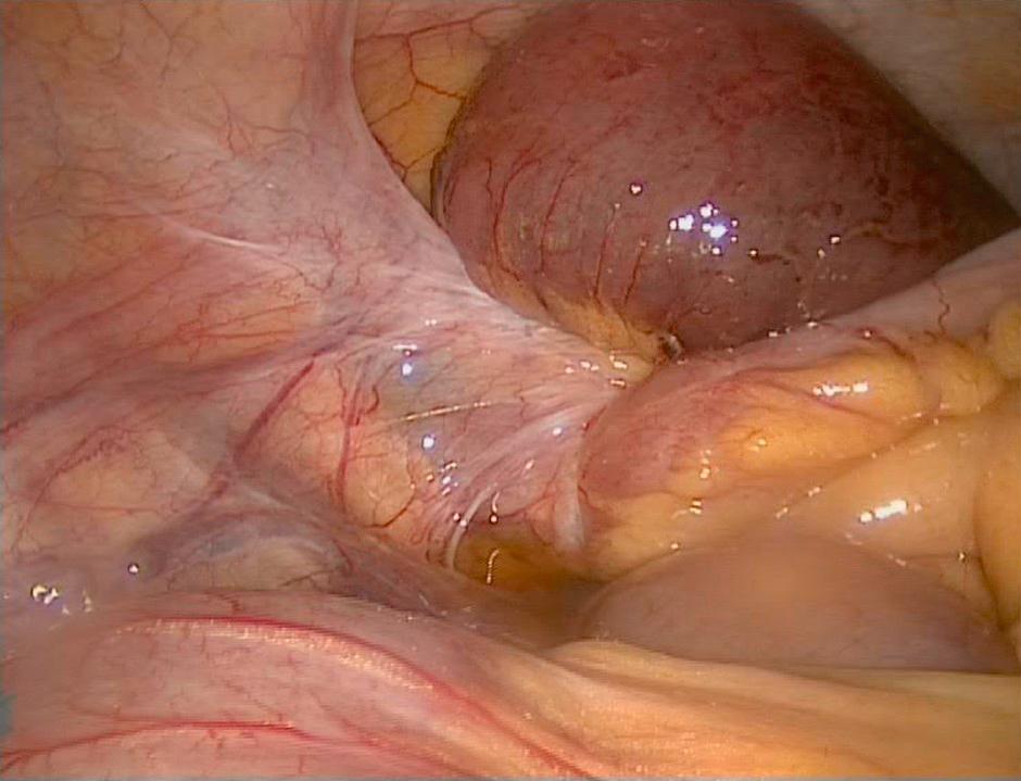 Figure 15.3, Laparoscopic view of a dilated loop of small bowel proximal to an adhesive band from a gynaecological procedure.