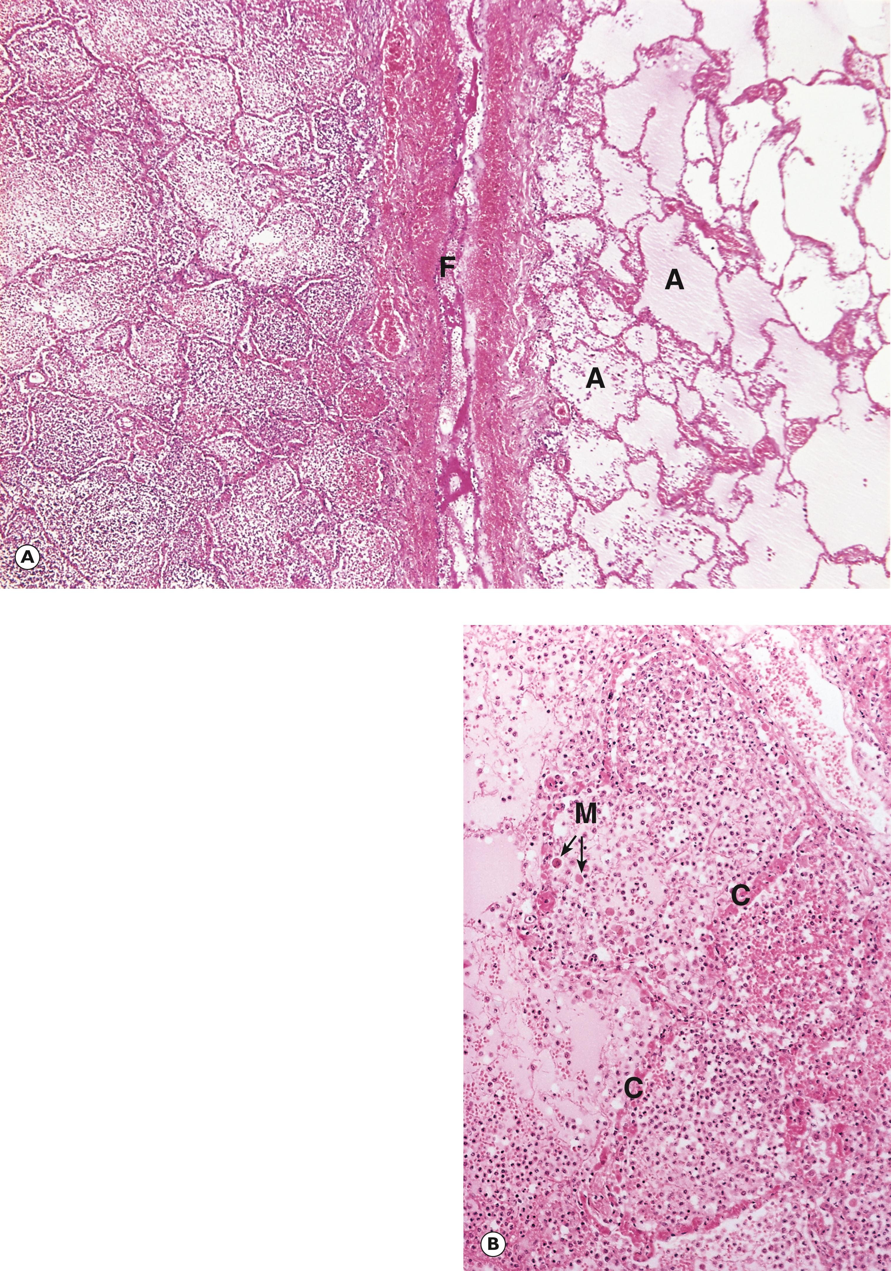 Fig. 3.3, Established acute inflammation: lobar pneumonia. (A) LP; (B) MP.