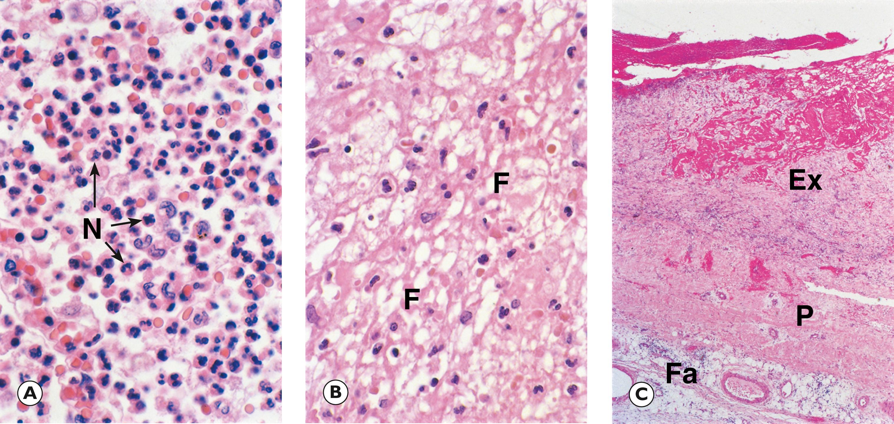 Fig. 3.4, Acute inflammatory exudate. (A) Neutrophilic exudate (HP); (B) highly fibrinous exudate (HP); (C) fibrinous inflammation: acute pericarditis (LP).