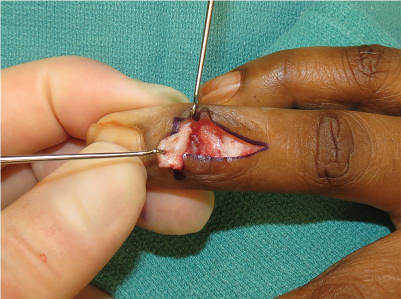 FIGURE 82.9, Repair of open mallet injury.