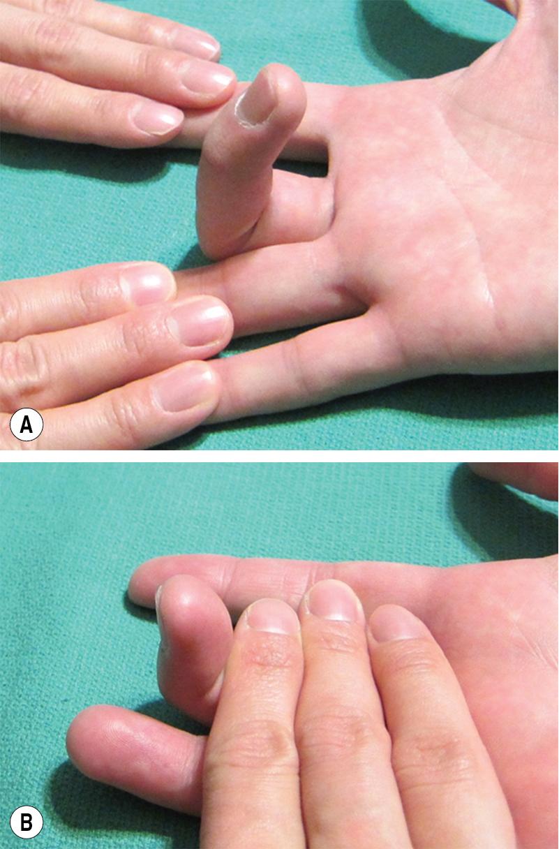 FIGURE 78.1, (A–B) Evaluating the continuity of the flexor digitorum superficialis (FDS) and flexor digitorum profundus (FDP).