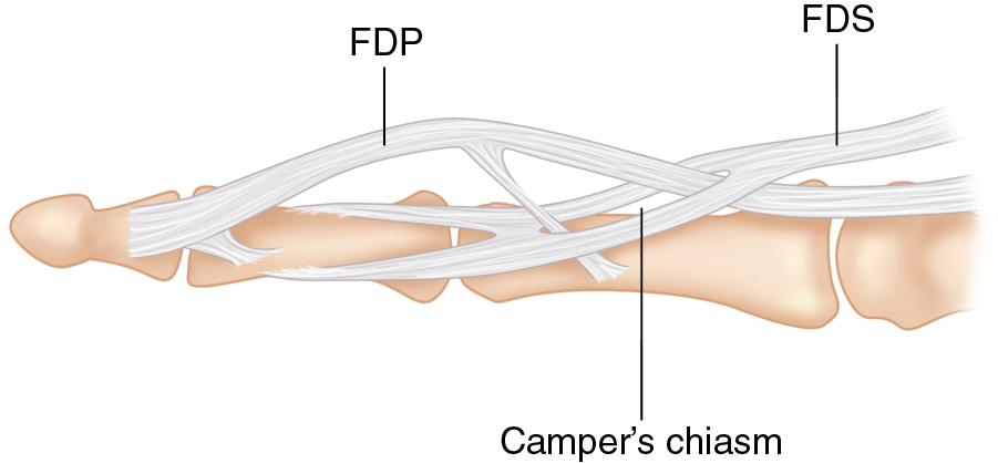 FIGURE 78.2, Illustration of flexor digitorum superficialis (FDS) and flexor digitorum profundus (FDP) insertion.