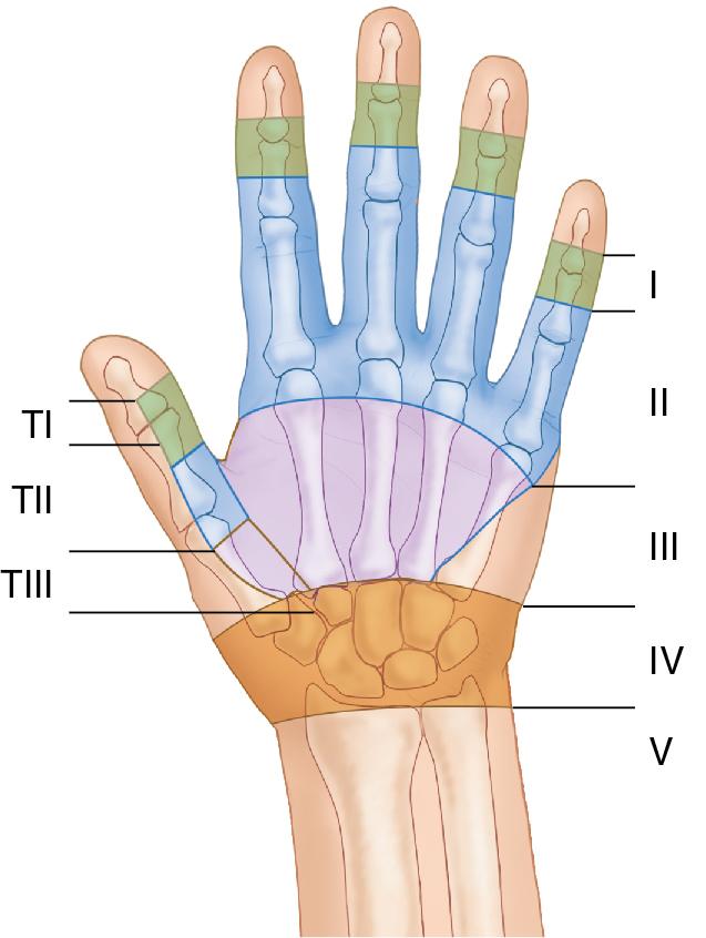 FIGURE 78.3, Zones of injury for flexor tendons.