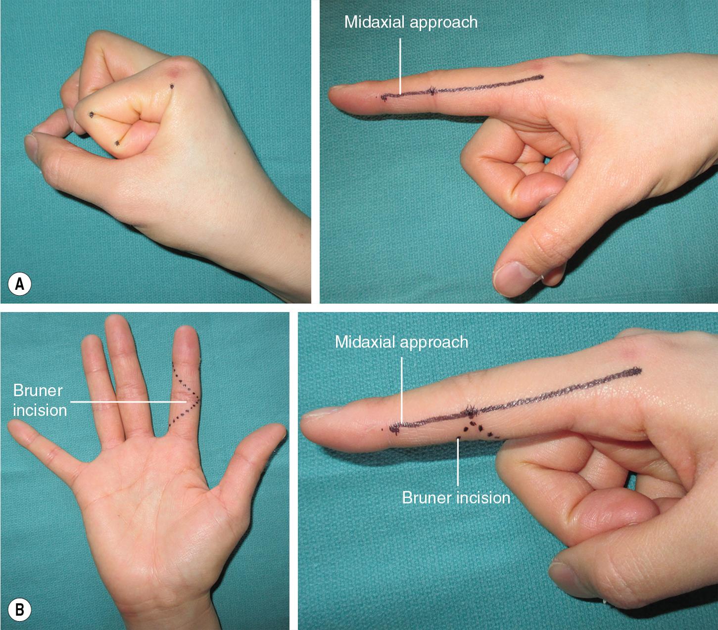 FIGURE 78.4, (A–B) Midaxial and Bruner incisions.