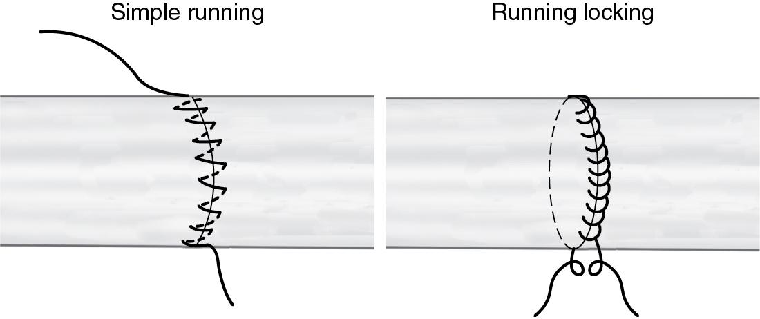 FIGURE 78.7, Epitendinous repair.