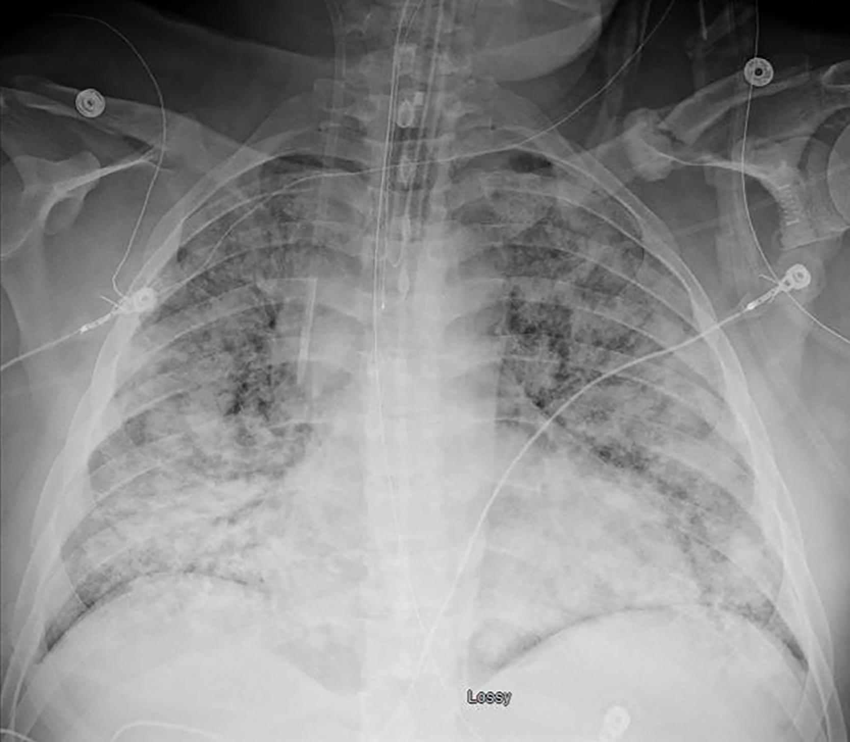 FIGURE 2, Chest radiograph findings with diffuse bilateral pulmonary infiltrates.