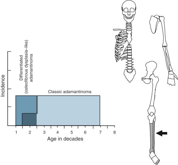 FIGURE 17-2, Adamantinoma of long bones.