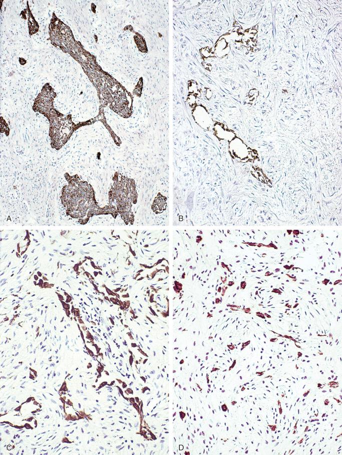 FIGURE 17-13, Classic adamantinoma: immunohistochemical features.