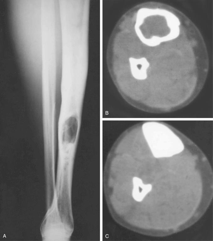 FIGURE 17-4, Plain radiograph and corresponding computed tomograms of adamantinoma of tibia.