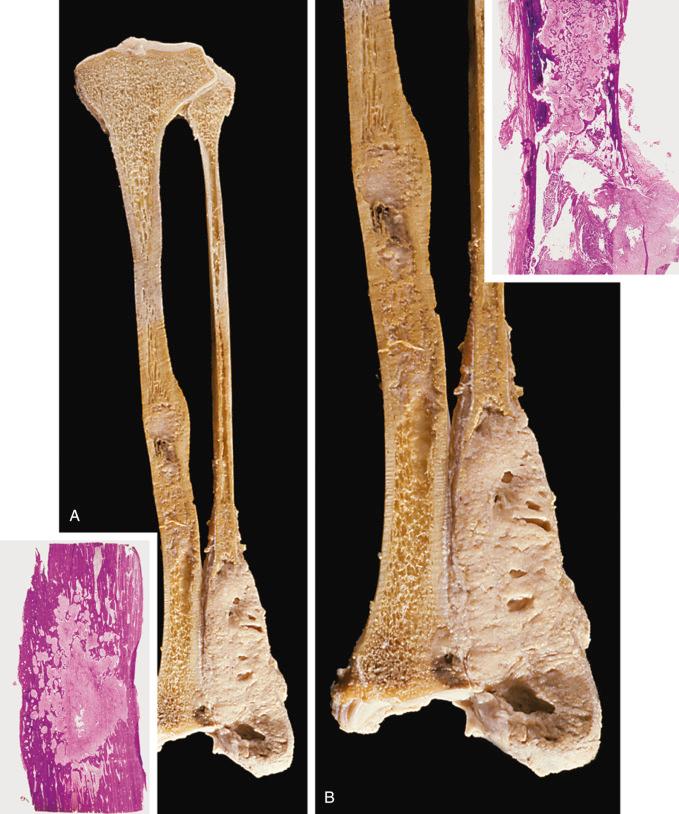 FIGURE 17-5, Classic adamantinoma: gross features.