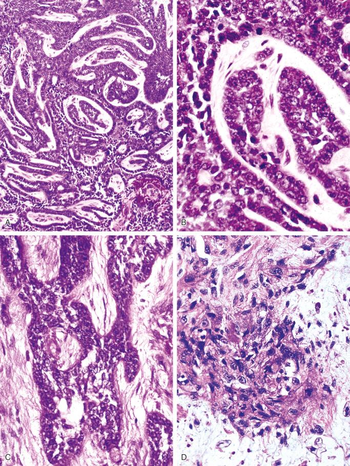 FIGURE 17-8, Adamantinoma: microscopic features.