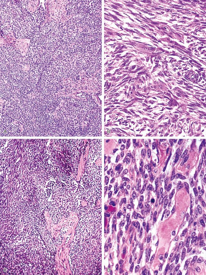 FIGURE 17-9, Classic adamantinoma: microscopic features.