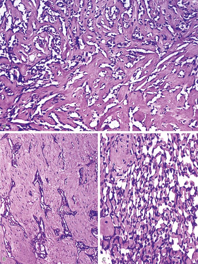 FIGURE 17-10, Classic adamantinoma: microscopic variations of tubular pattern.