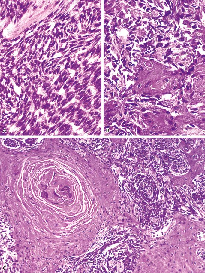 FIGURE 17-11, Spindled and squamous patterns of adamantinoma.