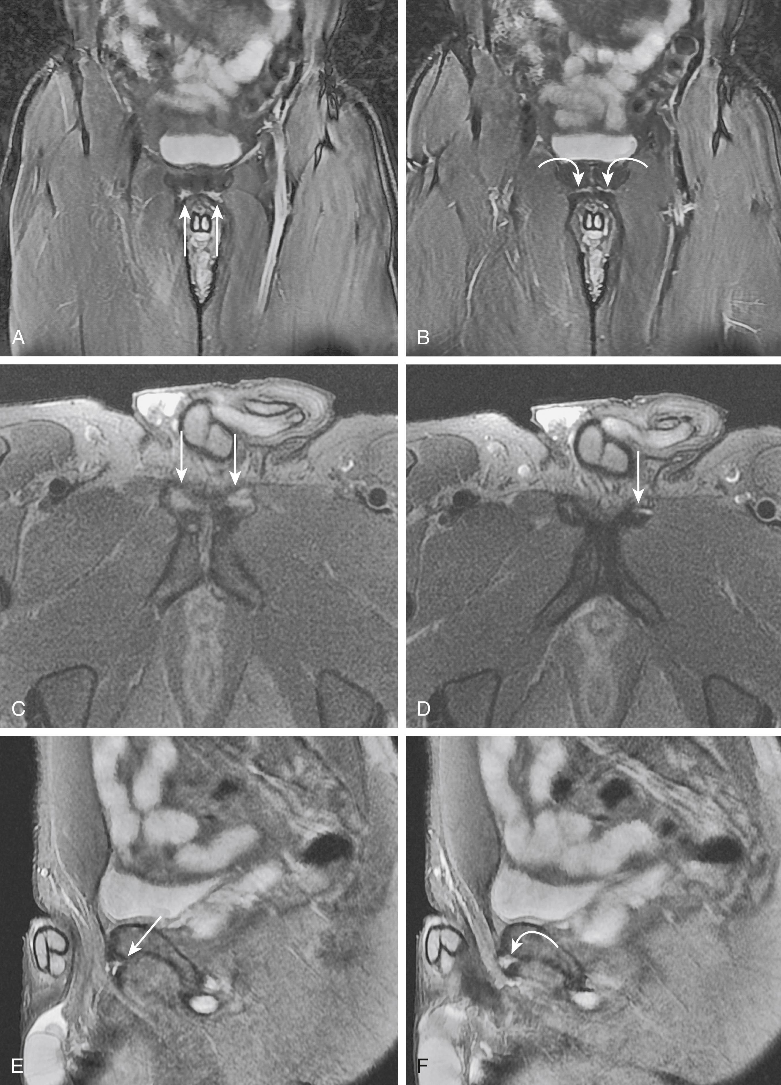 FIG. 124.2, A, Coronal fat-saturated T2-weighted magnetic resonance (MR) image. Bilateral severe adductor longus origin tendinosis (arrows) . B, Coronal fat-saturated T2-weighted MR image. Bilateral secondary clefts extending from the pubic symphysis into the adductor attachments, indicating some disruption of the prepubic aponeurotic complex tissue (curved arrows) . C, Axial fat-saturated T2-weighted MR image demonstrating bilateral adductor longus tendinosis (arrows) . D, Three-dimensional axial fat-saturated T2-weighted MR image. Small tear of the left adductor longus tendon (arrow) . E, Sagittal fat-saturated T2-weighted MR image. Small tears of the origin of the left adductor longus tendon (arrow) . F, Sagittal fat-saturated T2-weighted MR image. This image demonstrates more severe adductor longus tendinosis that involves the prepubic aponeurotic complex (curved arrow) .