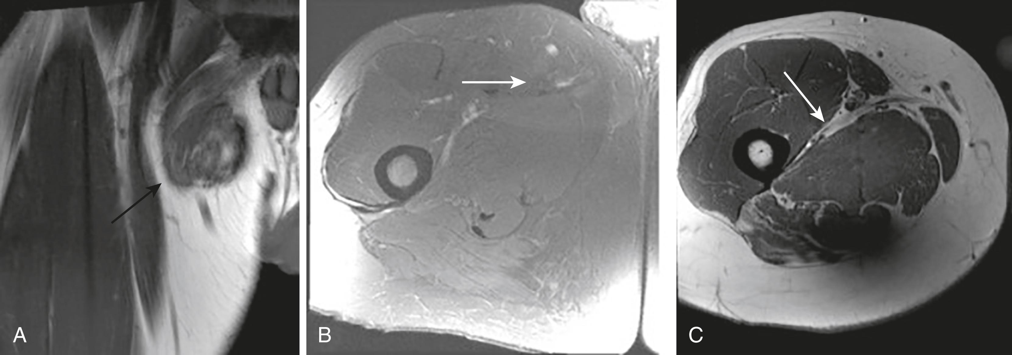 FIG. 124.3, A T1 coronal magnetic resonance sequence (A) and axial short tau inversion recovery magnetic resonance sequence (B) show a chronically retracted adductor longus muscle belly (black arrow) at the proximal medial right thigh with abrupt termination evidenced by lack of continuation on the short tau inversion recovery image (white arrow) . C, A T1 axial MR sequence shows only thin disorganized strands of T1 hypointense scar along the course of the adductor longus muscle to the femoral attachment (arrow) .