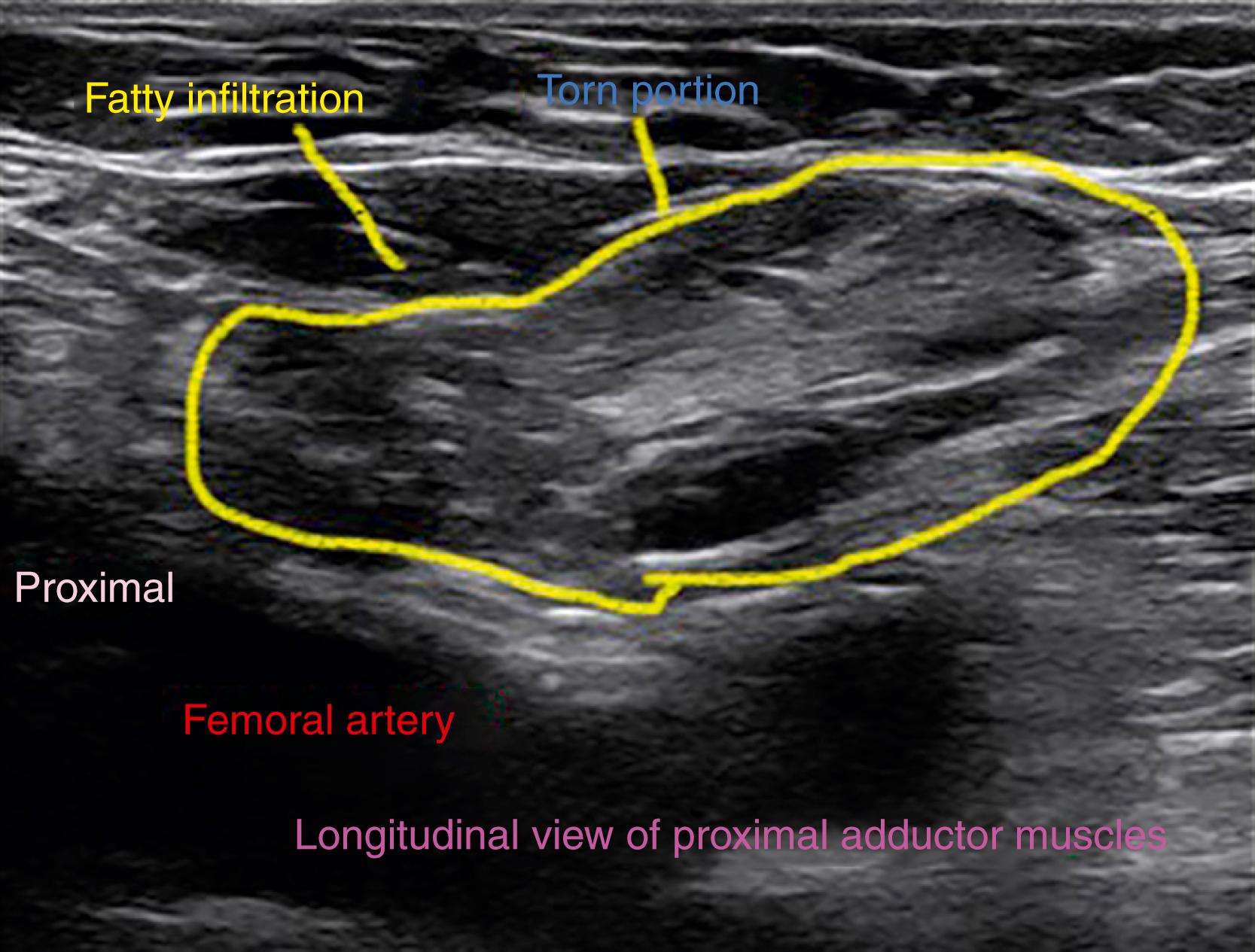 FIG. 124.4, Longitudinal ultrasound image demonstrating a tear of the adductor muscles. Note the fatty infiltration.