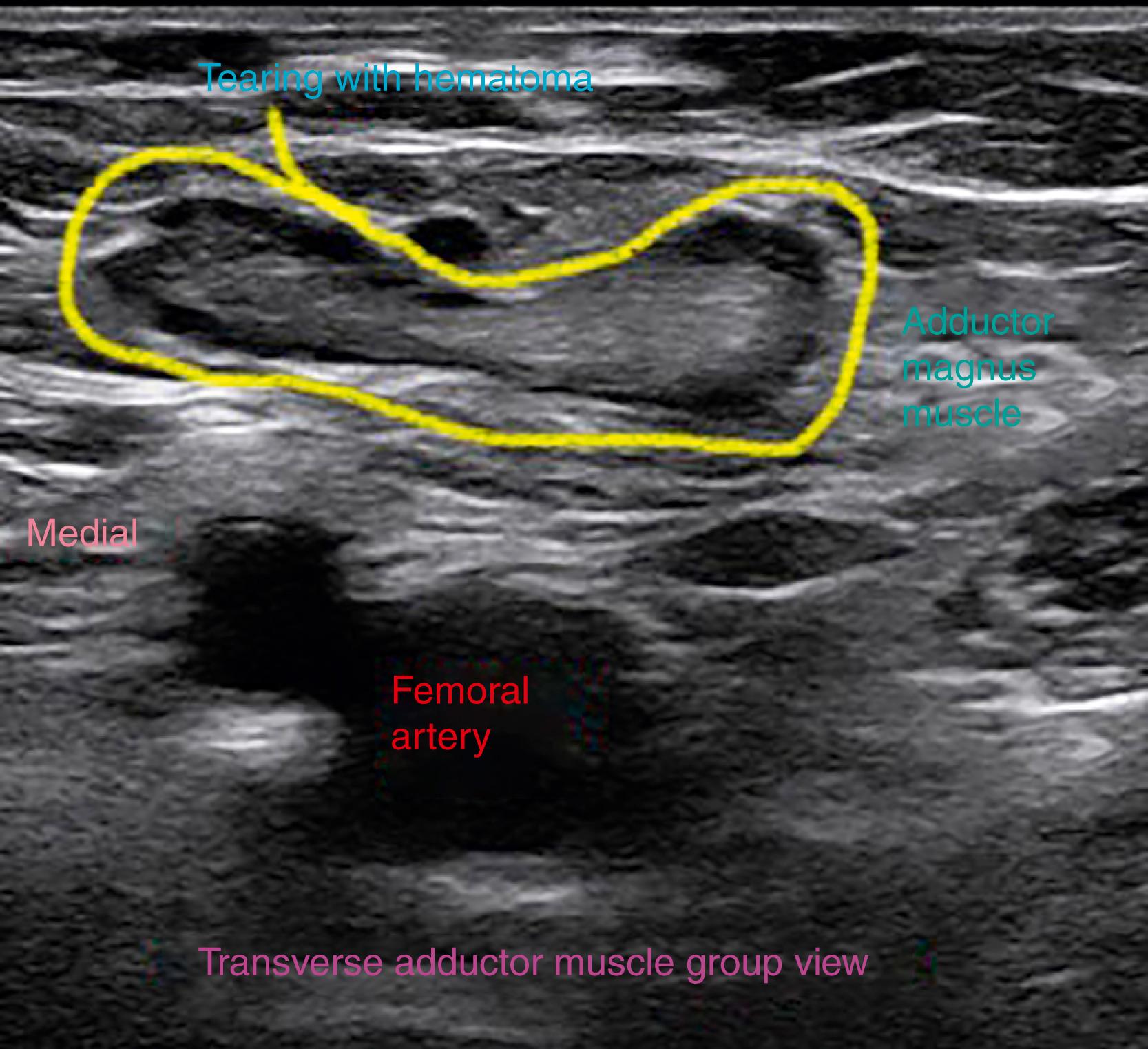 FIG. 124.5, Transverse ultrasound image demonstrating an acute tear of the adductor muscles. Note the hematoma surrounding the tear.