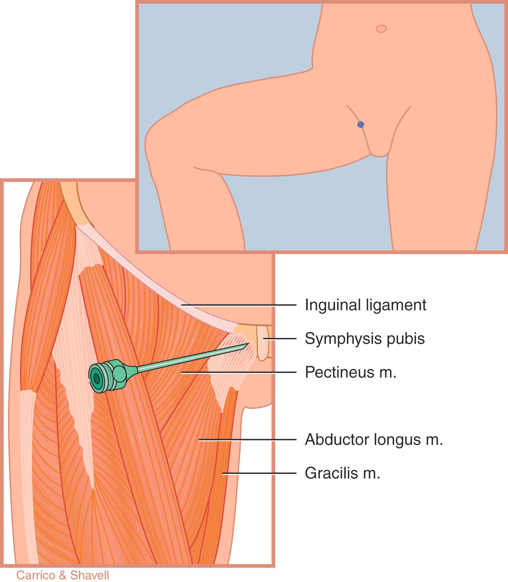 FIG. 124.6, Proper needle placement for injection of the adductor tendon. m ., Muscle.