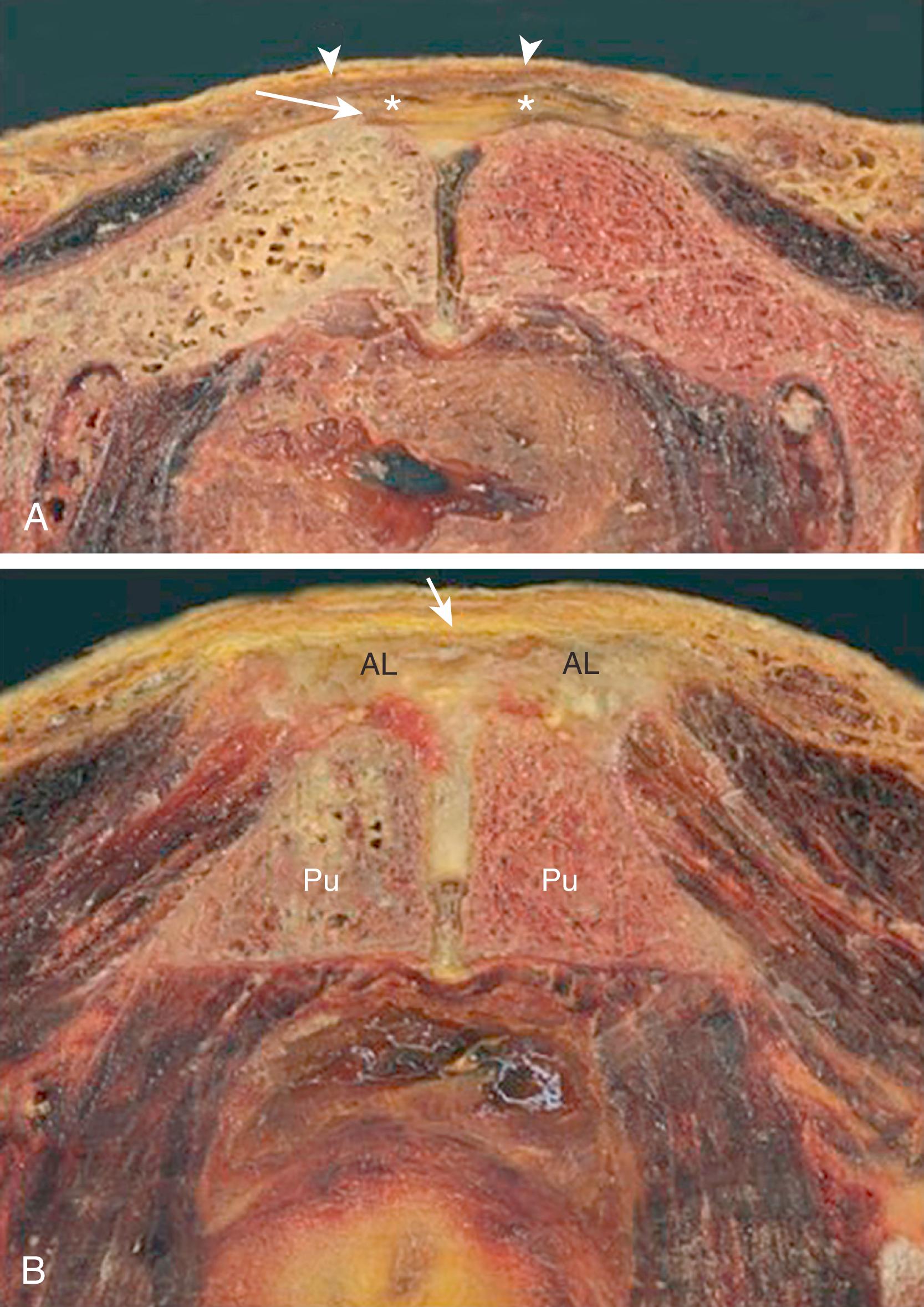 FIG. 124.8, A, At level 2, the anterior (arrowheads) and posterior aponeurosis (arrow) are seen. Note pyramidalis muscles in between (asterisks) . B, At level 3, the bulk of the adductor longus tendons is seen (AL) inserting on the pubic bone and cross connecting via the anterior pubic ligament (arrow) .