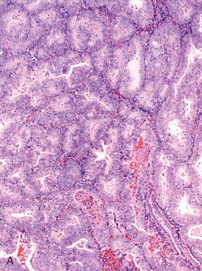 Fig. 19.11, Endometrioid adenocarcinoma (A) exhibiting focal staining for p53 (B). This would be considered a wild-type pattern for p53 and not in keeping with a TP53 mutation.