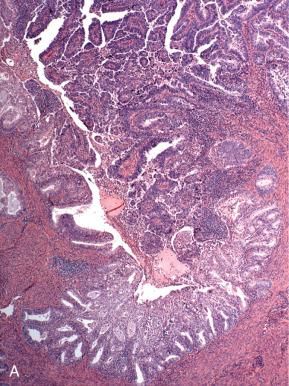 Fig. 19.12, A true combined endometrioid (lower) and serous (upper) carcinoma (A) also exhibits a biphasic p53 staining pattern at low power (B) and high power (C).