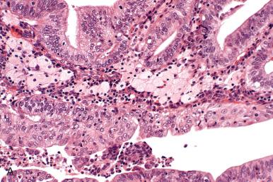 Fig. 19.14, A, Foamy histiocytes are frequently associated with endometrial cancer (center). B, Macrophages are not specific and are more commonly seen with benign conditions.