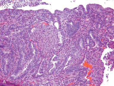 Fig. 19.15, The spectrum of squamous differentiation in endometrial cancer. A, Morules. B, Foci of squamous differentiation alone. C, Squamous differentiation with a higher grade glandular pattern. D, Well-differentiated papillary (condyloma-like) squamous patterns.