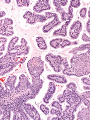 Fig. 19.18, Micropapillary architecture in an adenocarcinoma with mucinous differentiation. Note the coexisting squamous differentiation.