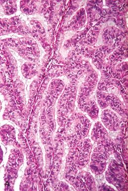 Fig. 19.19, A, Mucinous adenocarcinoma of the endometrium composed of larger glands. B, Free papillae from a mucinous carcinoma.