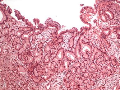 Fig. 19.20, Endometrial adenocarcinoma with gastric (A) and intestinal differentiation (B).